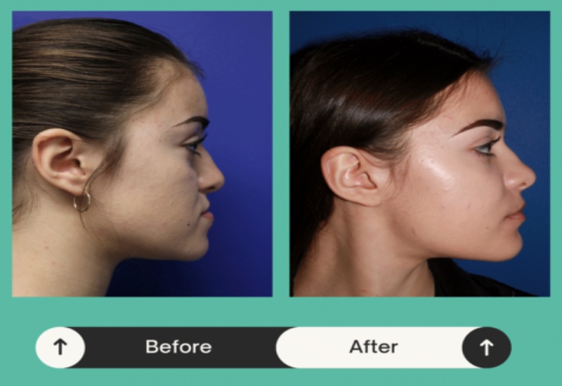 Before & after comparison showing the side view of a woman's face after facial treatment in Atlanta