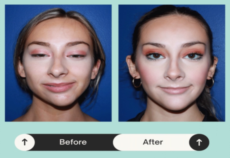 Side-by-side image illustrating improvement after successful facial treatment in Atlanta, GA
